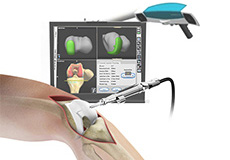 Computer Navigation for Total Knee Replacement