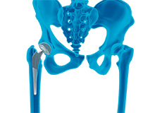 Correction of a Loose Hip Replacement