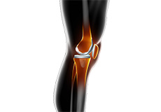 Correction of a Painful Knee Replacement