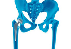 Outpatient Hip Replacement